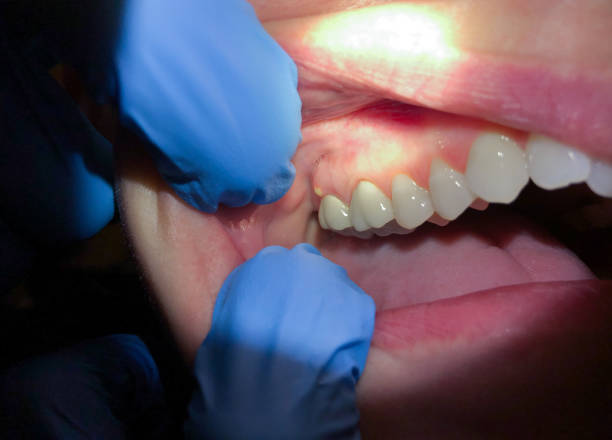 Best Emergency Dental Care for Broken or Chipped Teeth in Hatboro, PA